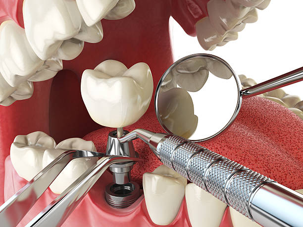 Best Emergency Broken Tooth Repair in Brea, CA